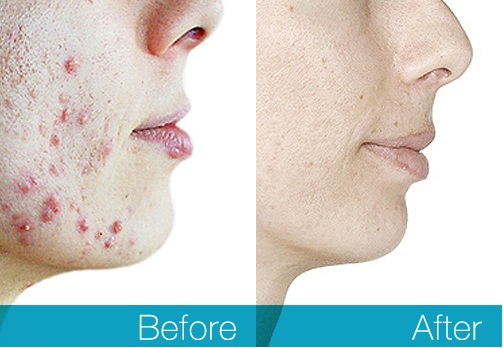 Acne Results