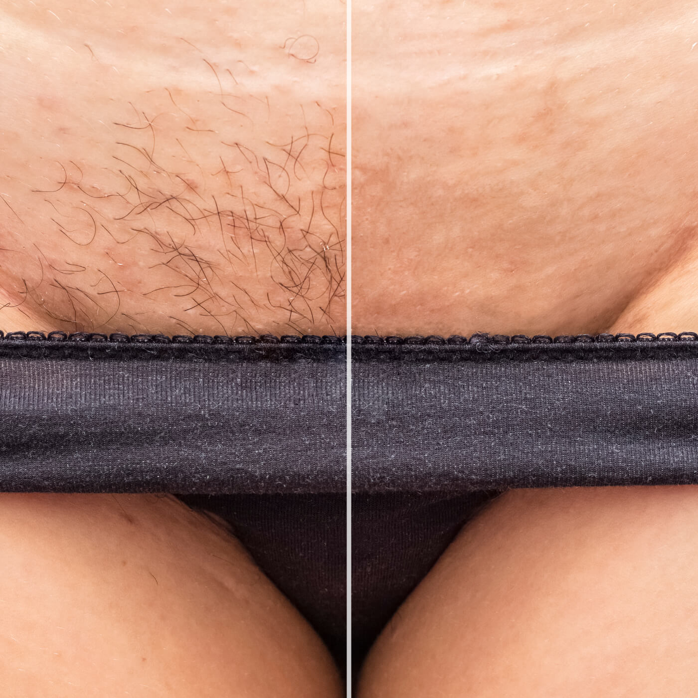 Battle of the Bikini: Comparing Brazilian & Bikini Hair Removal Methods | Nad's Hair Removal Blog